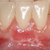 Des techniques chirurgicales minutieuses pemettent de repositionner la gencive dans sa position initiale