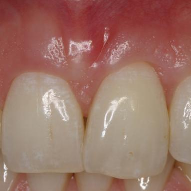 après repositionnement chirurgical de la gencive
